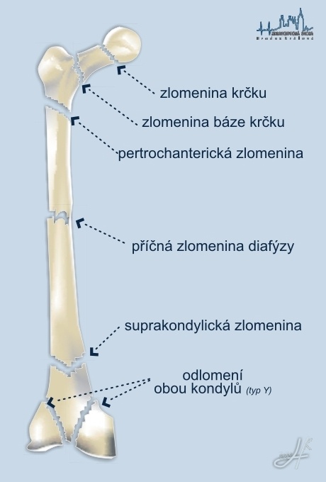 Typy zlomenin na příkladu stehenní kosti